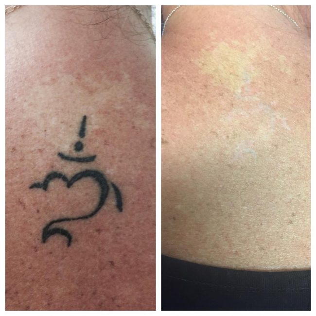 Tattoo Removal Before and After: How to Get Rid of Tattoo ...