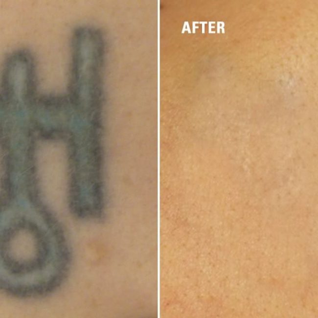 Tattoo Removal Before and After: How to Get Rid of Tattoo ...