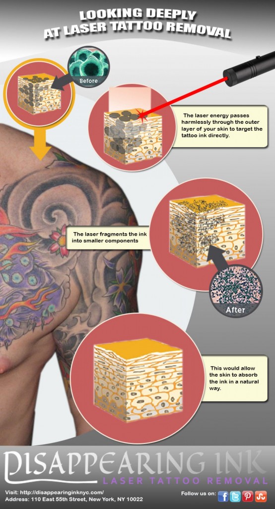 Tattoo Removal Before and After: How to Get Rid of Tattoo? Cream ...