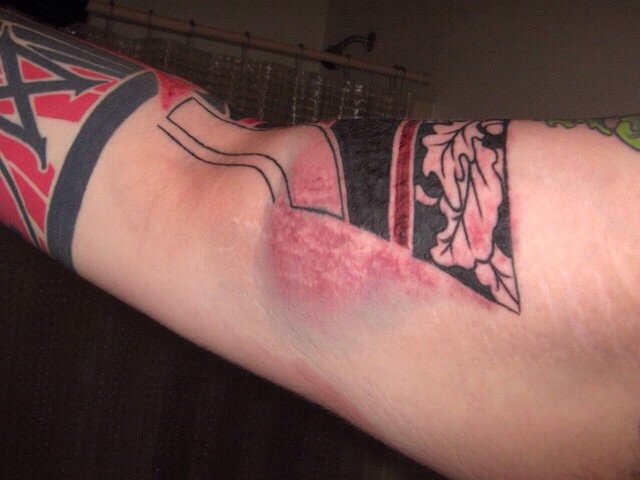 Red streaks on legs, no wound. Both legs burn painfully. A ...