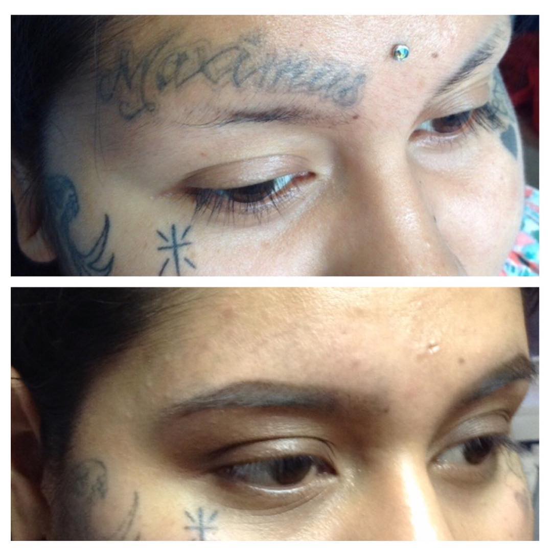 Tattoo Removal Before and After How to Get Rid of Tattoo? (2019)