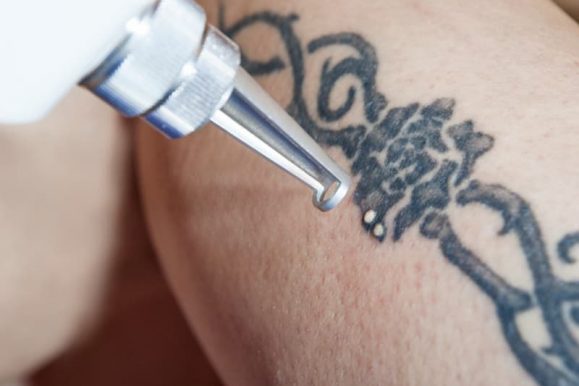 The best place for tattoo removal in Philadelphia – Learn more